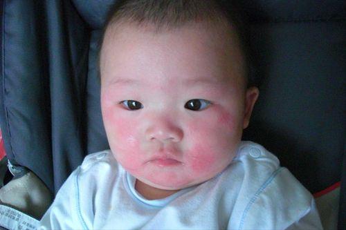 小孩吃白瓜过敏,警惕常见蔬果引发的健康危机